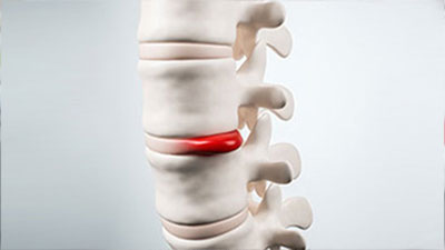 patient needs herniated disc chiropractor in Santa Maria CA