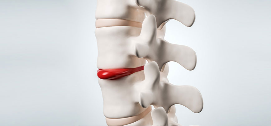 patient receiving herniated disc treatment in Santa Maria CA