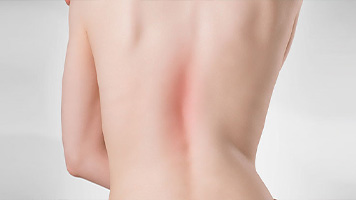 patient requiring scoliosis treatment in Santa Maria CA